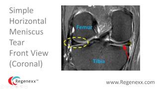 How to Read a Knee MRI for Meniscus Tears [upl. by Dremann736]