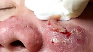 Acne Cysts The Extended Cut [upl. by Ovida]