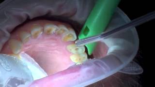 Laser Assisted Root Canal on Upper Bicuspid 12 [upl. by Rockwood583]