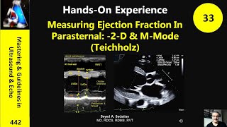 Measuring Ejection Fraction In Parasternal 2D amp MMode Teichholz [upl. by Eleets871]