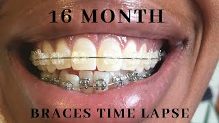 Full Braces Time Lapse  Adult Braces Before amp After [upl. by Anelrahs]