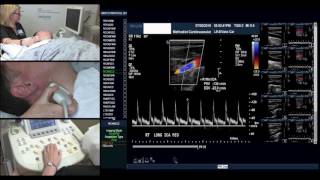 Carotid Protocol Esther Collado RN RVI [upl. by Cresida857]