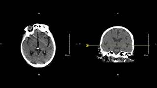 Unremarkable NonContrast Head CT Axial Scan  Example 1 [upl. by Leacim855]