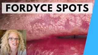 SYRINGOMA VS FORDYCE SPOTS  NATURAL REMEDIES [upl. by Belak259]