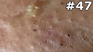 quot🔴 Satisfying Pimple Popping Extravaganza Watch the Most Satisfying Pops Everquot 47 [upl. by Ahsoyem]