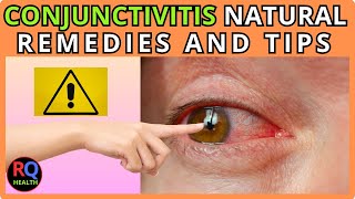 049  quotConjunctivitis Causes Symptoms and Natural Remedies to Cure Itquot [upl. by Obie357]