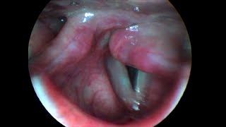 Unilateral Left Vocal Cord Paralysis [upl. by Max]