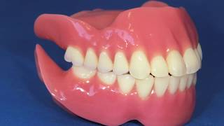 Upper amp Lower Severe Resorption OM DENTURE SYSTEM [upl. by Cart729]