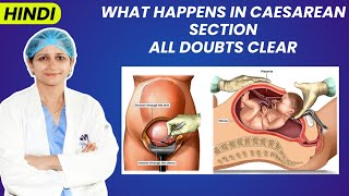 Everything You Need to Know About Caesarean Section in Hindi  Dr Jyoti Gynecologist [upl. by Mackey744]