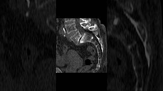 L5S1 grade 2 spondylolisthesis with microfractures degenerative changes in the pars interarticulari [upl. by Belden33]