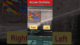 Scrotal Doppler showing Acute Orchitis💯😭 ultrasound doppler medical radiology shorts viral [upl. by Shornick944]