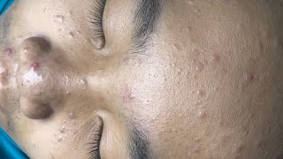 ACNE TREATMENT VU QUYNH MI  Blackheads Chin amp Nose Of Tweens 2024 EX [upl. by Trotter]