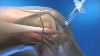 Learn More About Euflexxa Injections [upl. by Enirehtacyram]