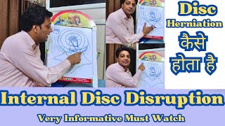 Internal Disc Disruption  Mechanism Behind Disc Herniation  Dr Rajesh Sharma PT [upl. by Church880]