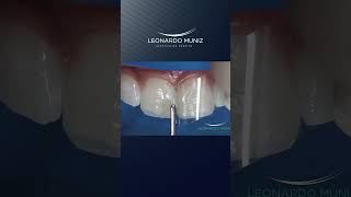 Alargamiento incisal con resinas compuestas [upl. by Ecnadnac]