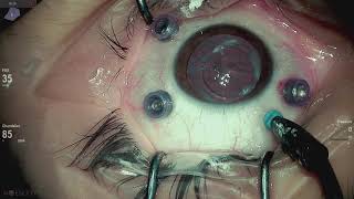 Retinal detachment repair Lukan Mishev live stream [upl. by Judith]