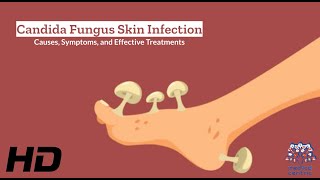 Candida Fungus Skin Infection Explained What You Need to Know [upl. by Oberstone89]