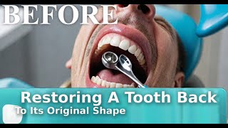 Restoring A Tooth Back To Its Original Shape  Dental Health Hub [upl. by Eno]