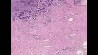 Histopathology Breast Ductal carcinoma [upl. by Edison]