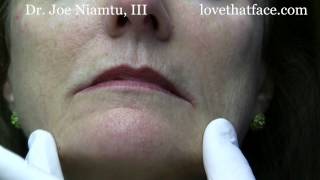 Botox Injection to DAO corner of mouth by Dr Joe Niamtu III [upl. by Murton]