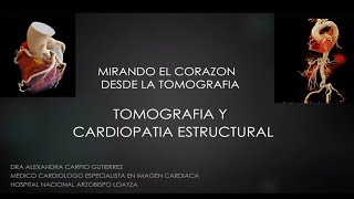 Tomografia y cardiopatia estructural  Dra Alexandra Carpio [upl. by Tdnerb862]