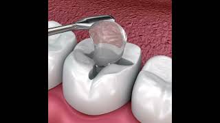 Teeth Inlays and Onlays  All Brite Dentistry inlay onlay dentist [upl. by Lamiv]