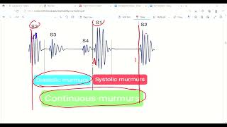 Heart murmurs Part2  Heart murmur sounds  Cardiovascular system  Lec 16 [upl. by Aerdna772]