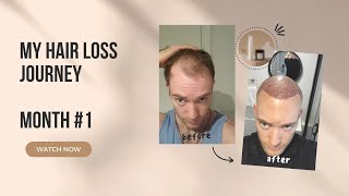 Hair Transplant Full Month HLC Clinic Turkey Review [upl. by Coppock751]