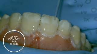 White spot treatment using infiltration with Icon  stepbystep [upl. by Thenna]