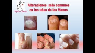 Anomalías de las uñas de las manos [upl. by Naji567]