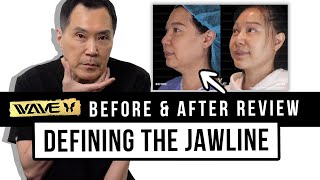 Face Lift Before amp After Review How to Tighten the Jawline and look Natural  Wave Plastic Surgery [upl. by Halle]