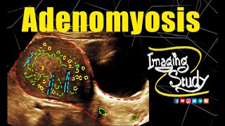 Adenomyosis  Uterus  Ultrasound  Case 330 [upl. by Ierbua]