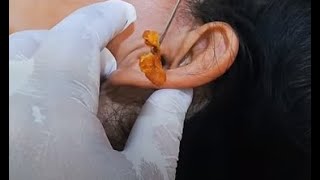 巨型耳朵粉刺黑頭粉刺 EAR CLEANING 16082020 [upl. by Lorri311]