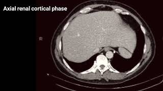 CT of Subcapsular perirenal hematoma [upl. by Center]