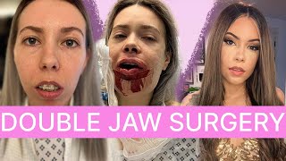 What Its Really Like Having Jaw Surgery [upl. by Nytram401]