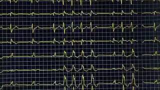 CARRERAS DE TAQUICARDIA PAROXISTICA SUPRAVENTRICULARES EN PACIENTE POSTANGUOPLASTIA EXITOSA [upl. by Jerz]