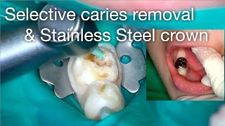 Selective caries removal amp stainless steel crown [upl. by Eixor425]