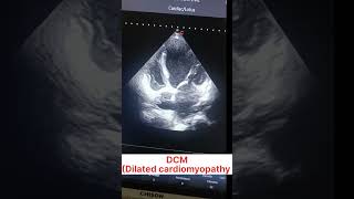 2D ECHO  DILATED CARDIOMYOPATHY  DCM  DCMP 2decho shorts medicine [upl. by Caye295]