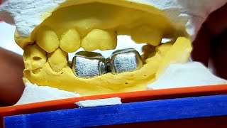 metal crowns finishingتشذيب وإنهاء التيجان المعدنية [upl. by Nnep]