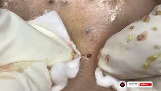 Big Cystic Acne Blackheads Extraction Blackheads amp Milia Whiteheads Removal Pimple Popping [upl. by Casmey]