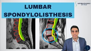 Degenerative Disc Disease Spondylosis explained by Spine Surgeon Dr Jessica Shellock Plano TX [upl. by Anauj]