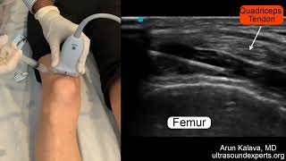 Ultrasound Guided Intraarticular Knee Injection [upl. by Silra]