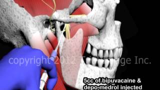 Bupivacaine Anesthesia of the Temperomandibular Joint TMJ  Animation by Cal Shipley MD [upl. by Natam]