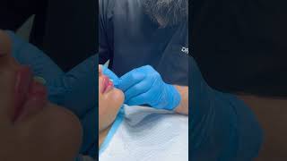 Lip Fillers Treatment [upl. by Quentin]