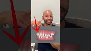 Overbite Correction with Invisalign Our Smile Design Plan [upl. by Chinua]