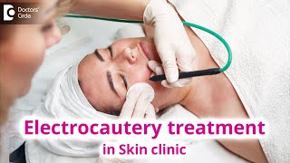 Use of Electrocautery Treatment in Skin Clinic  Electrocautery  Dr Rasya Dixit  Doctors Circle [upl. by Alahc]