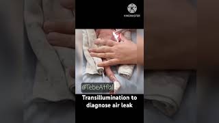 Transillumination to diagnose air leak l Pneumothorax neonatology [upl. by Adiel]