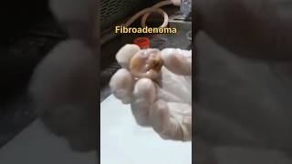 Fibroadenoma breast tissue for histopathology  satisfying histopathology [upl. by Yauqaj]