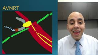 What is Supraventricular Tachycardia SVT [upl. by Kettie919]