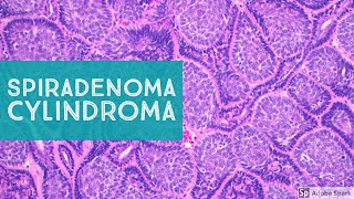 Spiradenoma amp CylindromaSweat Gland Tumor Pathology [upl. by Bartolomeo]